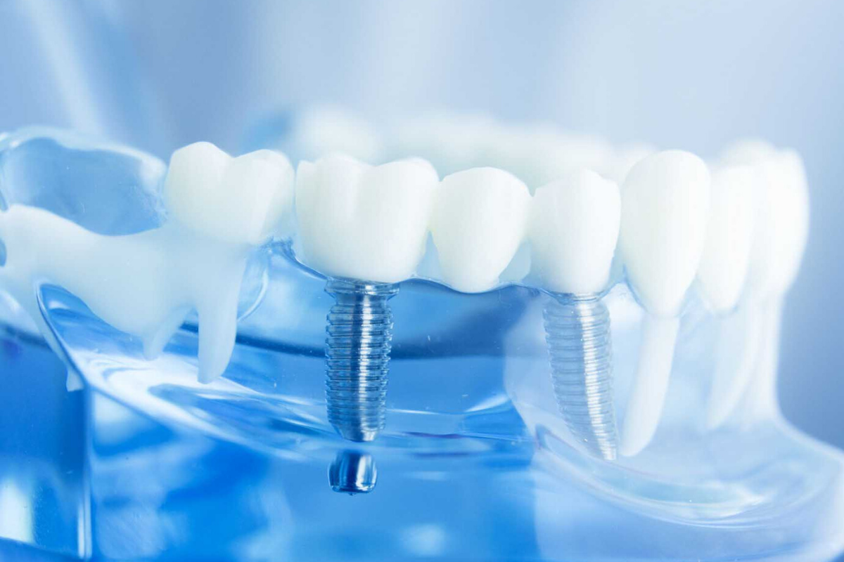 Discover Affordable All On 4 Dental Implants in Costa Rica