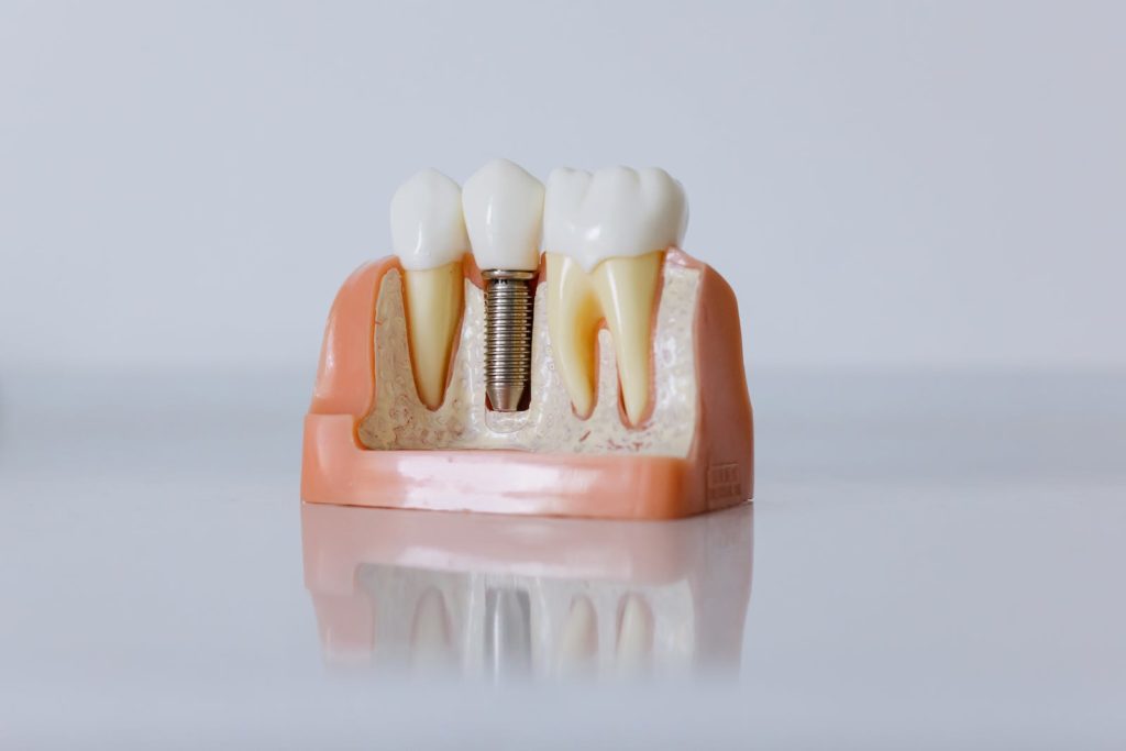 Dental Implants: The Revolutionary Breakthrough in Tooth Replacement in Costa Rica